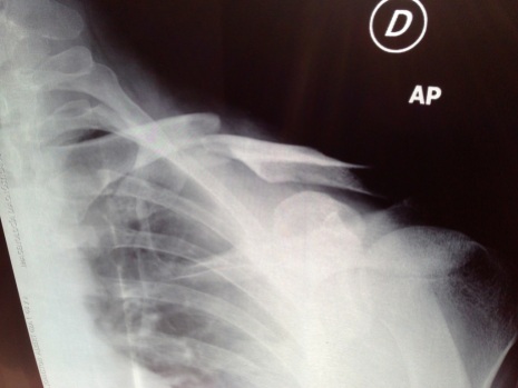 Neil's Horrible Clavicle